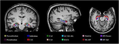 Brain Atrophy and Clinical Characterization of Adults With Mild Cognitive Impairment and Different Cerebrospinal Fluid Biomarker Profiles According to the AT(N) Research Framework of Alzheimer’s Disease